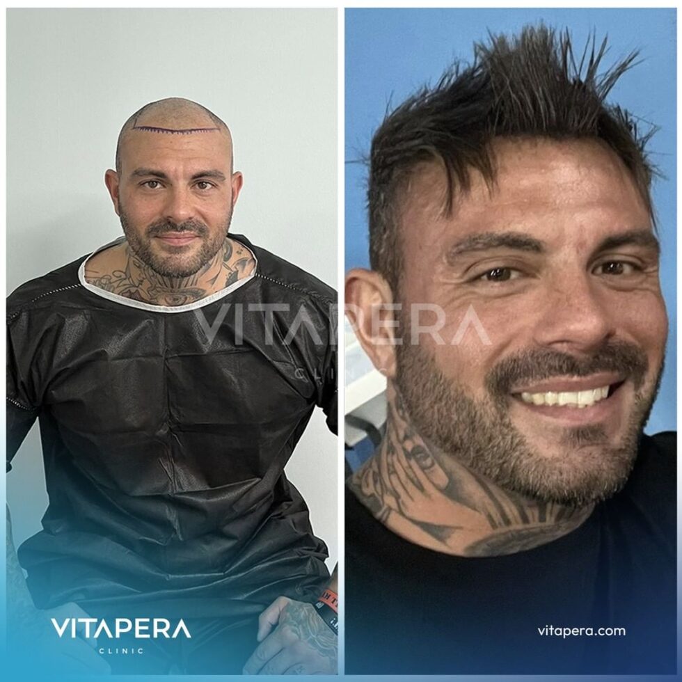 Top Hair Transplantation Solutions In Turkey Vitapera