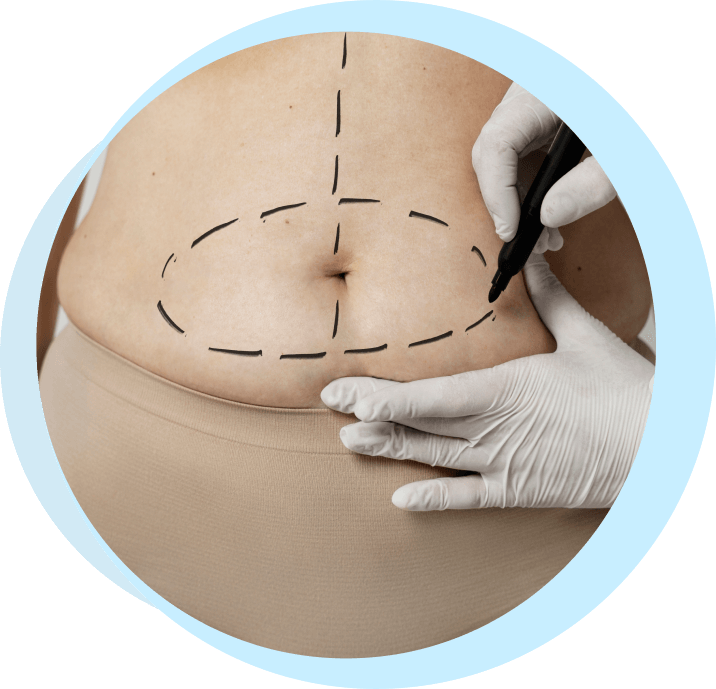 what are the risks of tummy tuck