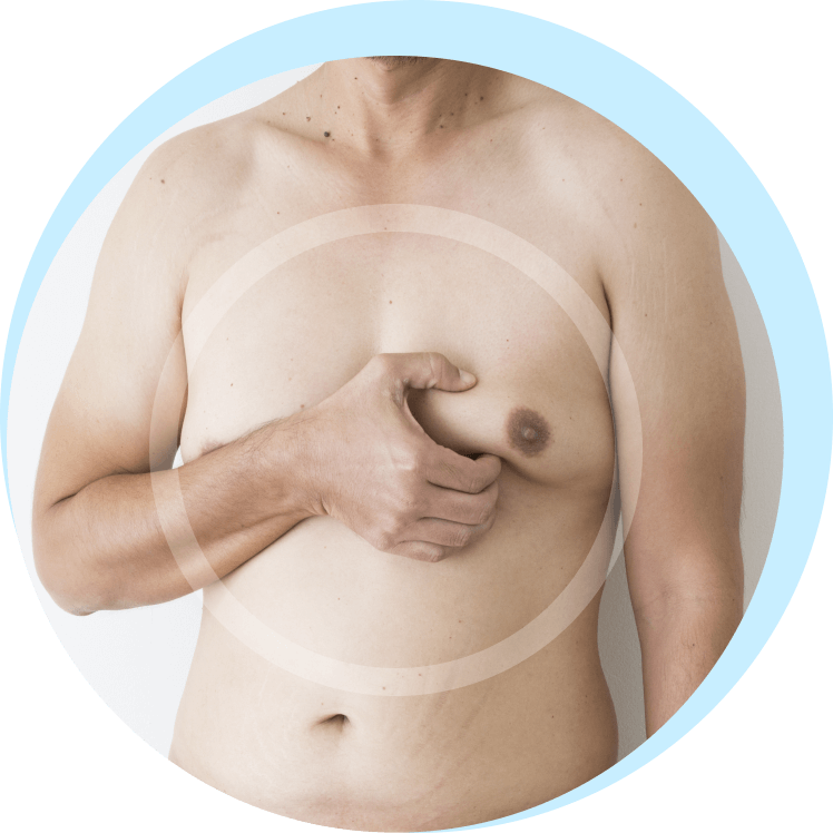 who can benefit from gynecomastia surgery