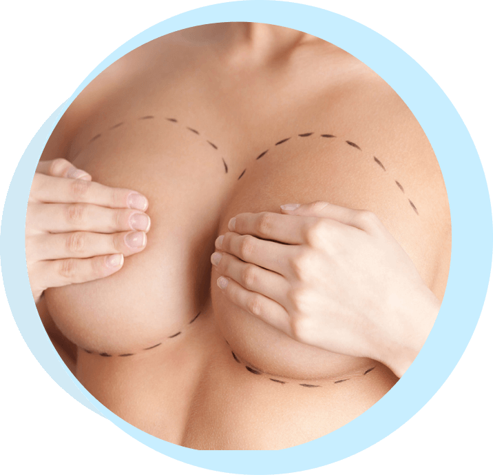 what should be expected from mastopexy plastic surgery