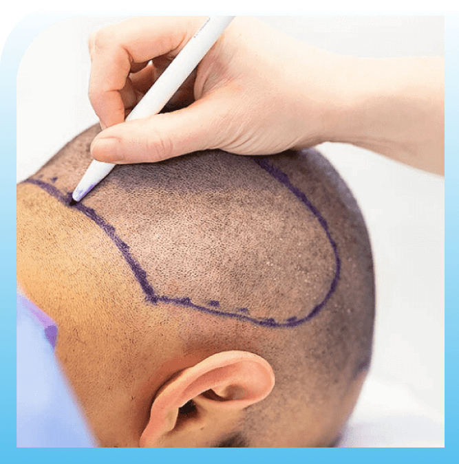 hair transplant process