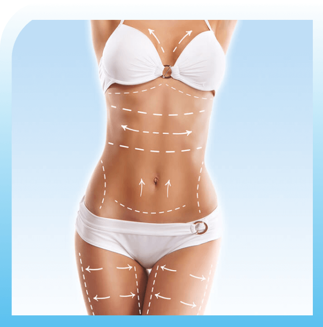 Great results of liposuction