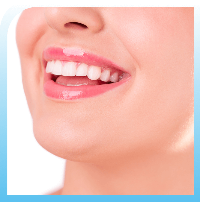 how veneers are applied on teeth