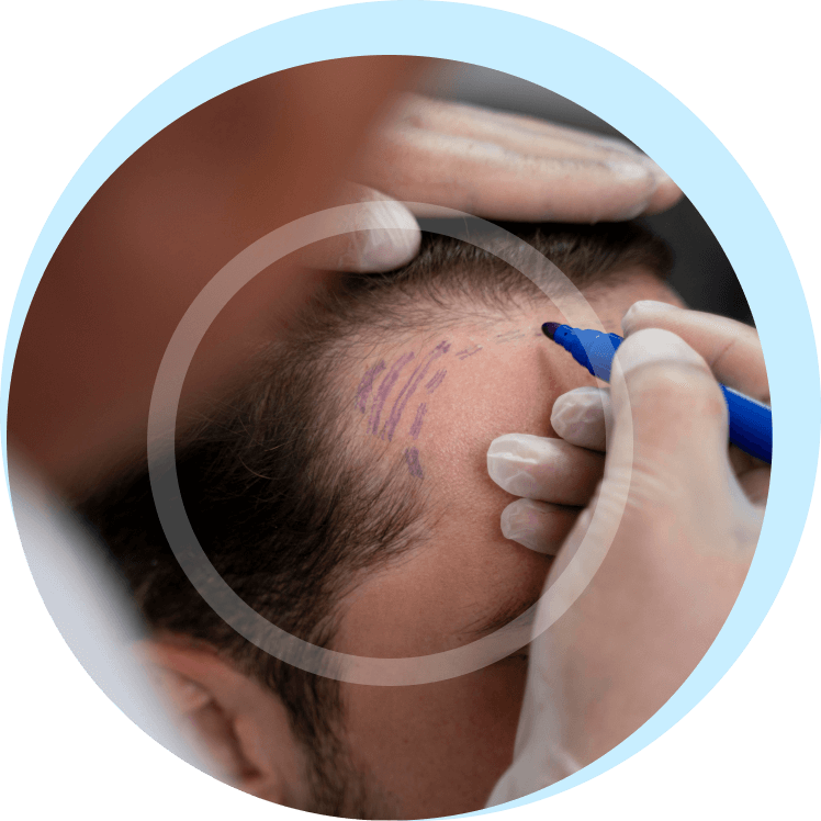 how is the dhi hair transplant method process