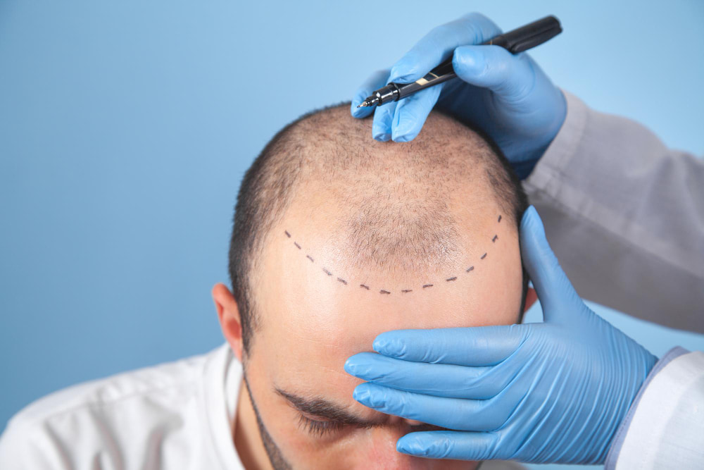 Bald man getting checked prior to his PRP hair treatment
