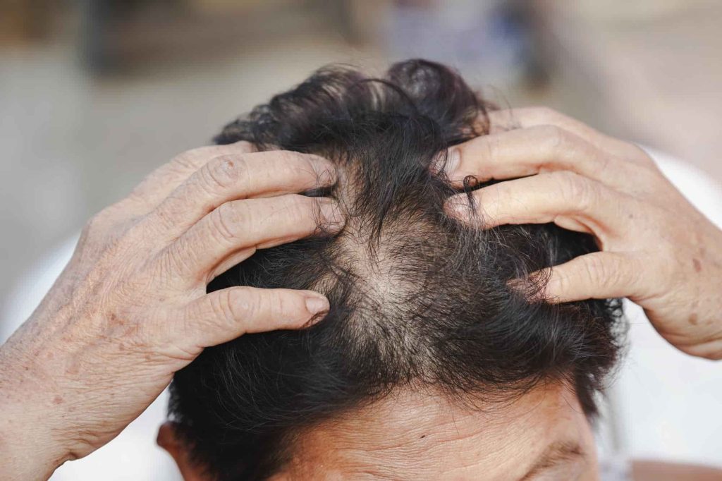 prp-hair-treatment-a-man-who-gets-bald
