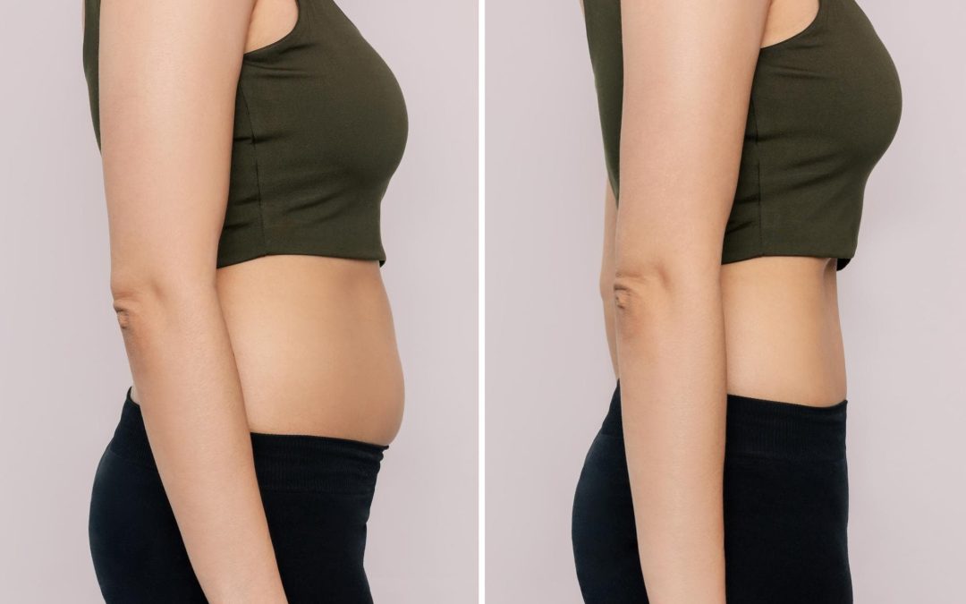 Liposuction Turkey: Effective and Affordable Body Contouring