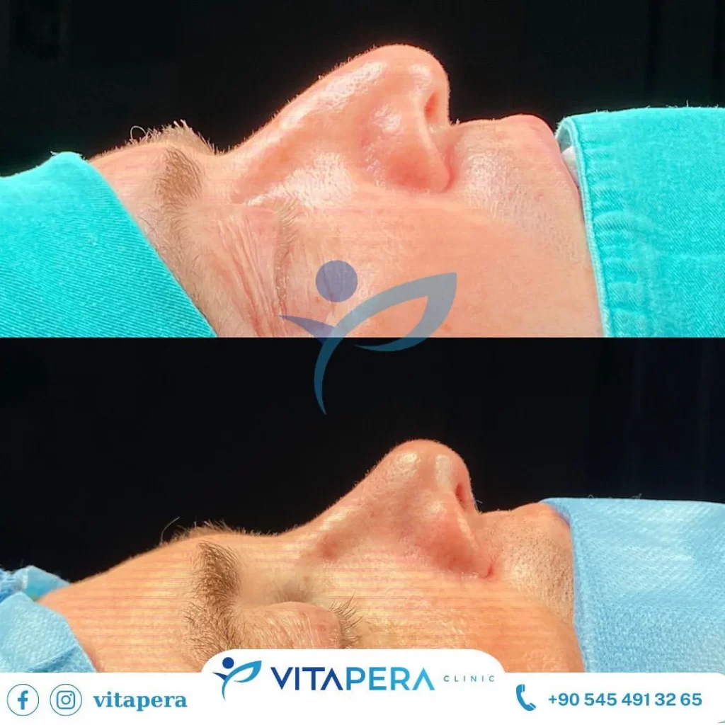 septoplasty