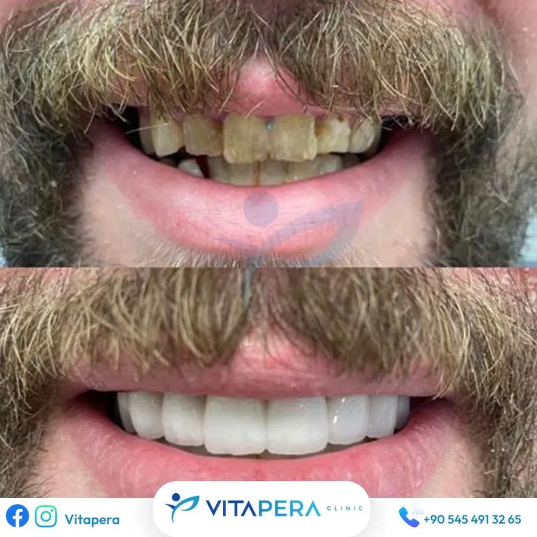 Laminate Veneers in Turkey A Smile Reborn ! Vitapera