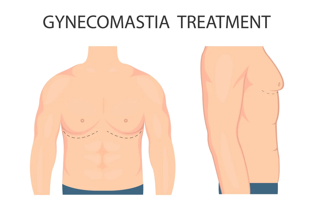 Gynecomastia In Turkey: 5 Benefits Of Male Breast Reduction surgery Gynecomastia