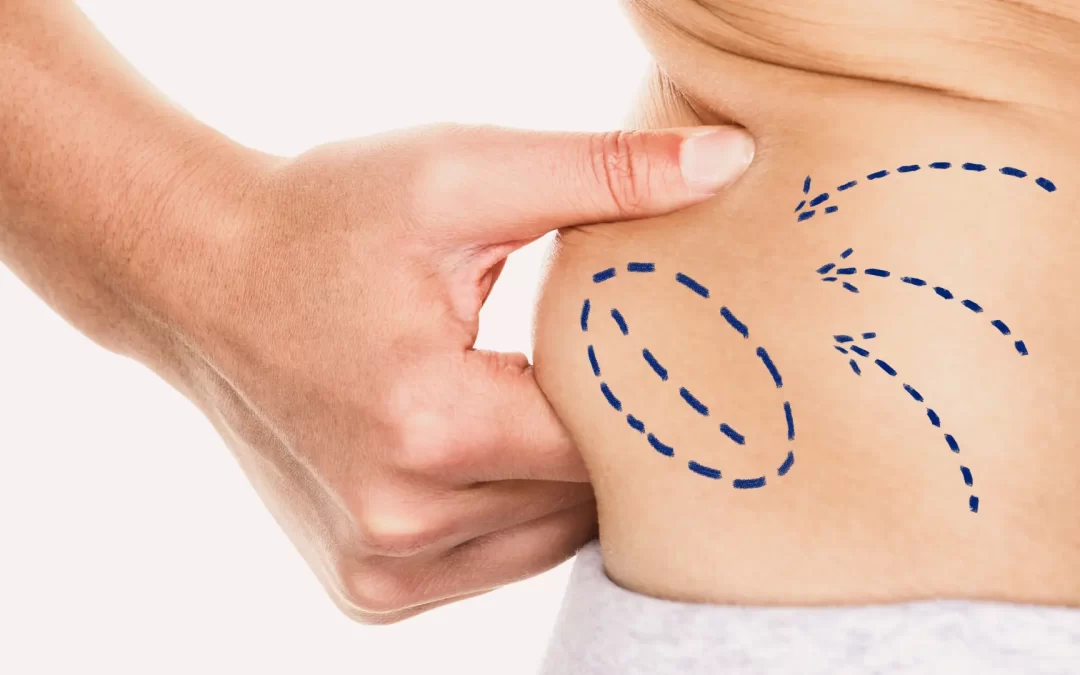 Can Fat Return After Liposuction Surgery?