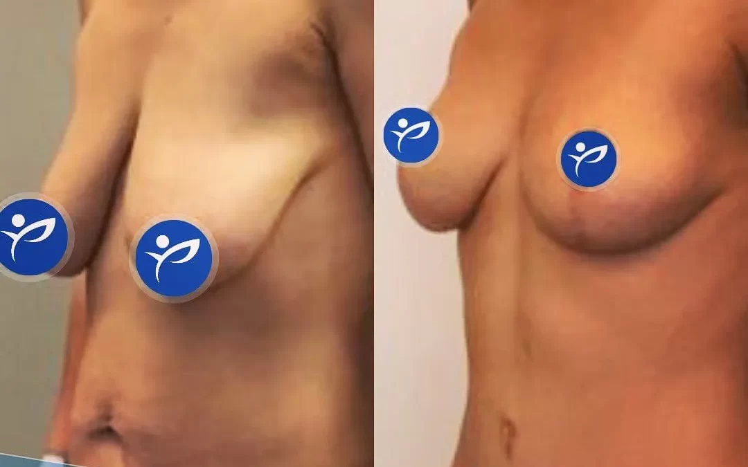 Breast Lift Recovery Guide: A Full Timeline