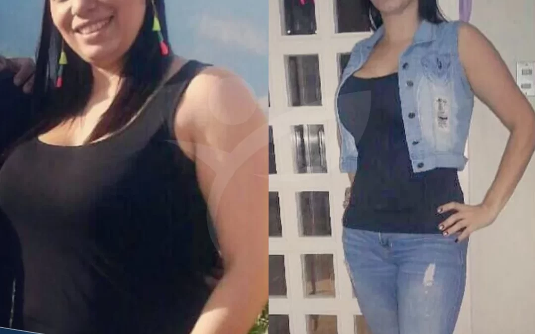 Vaser Liposuction Benefits and Why it’s Popular in Turkey