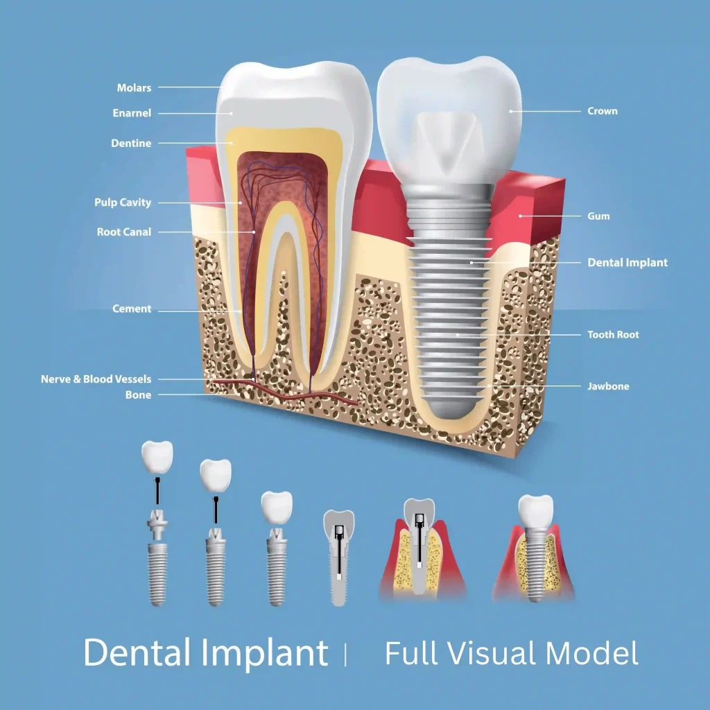 Your Visual Guide Dental Implants in Istanbul