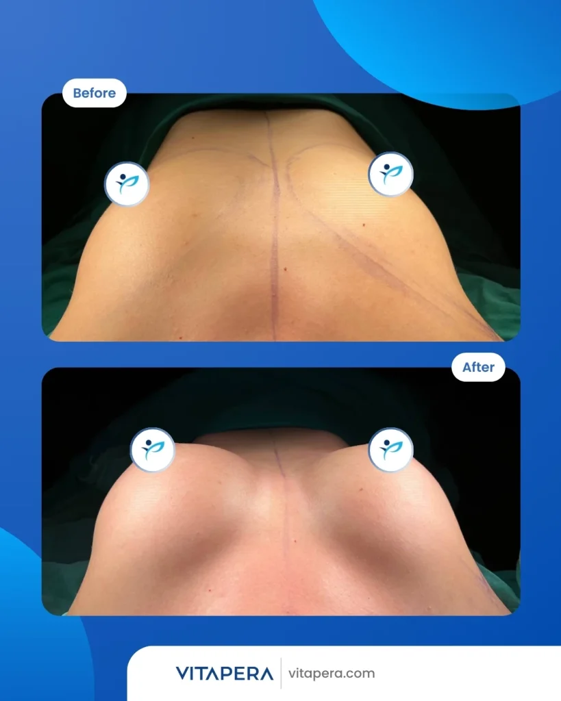 before after breast lift upside