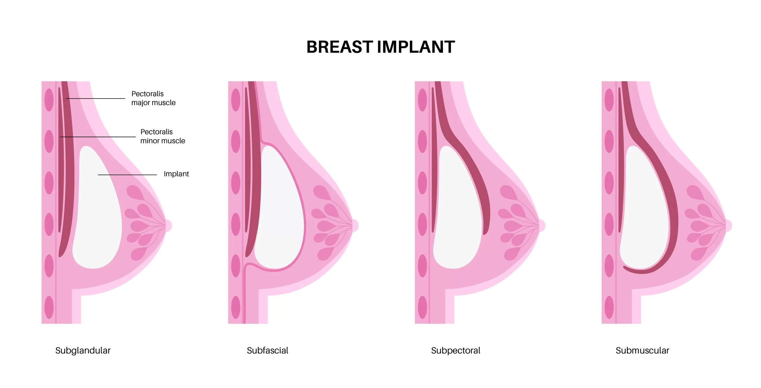 What are Tubular Breasts ? Breast Lift in Turkey Tubular Breasts