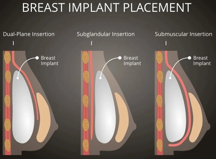 Breast Enlargement vs Breast Lift: Differences and Details