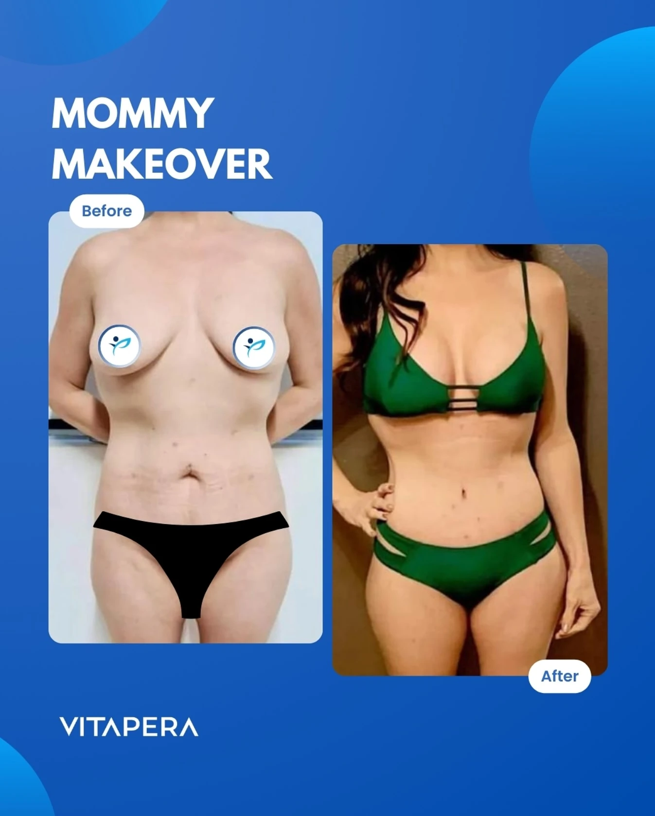 Motherhood surgery Our Results