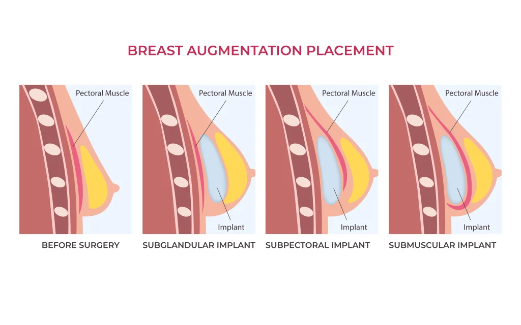 breast_implant_types_