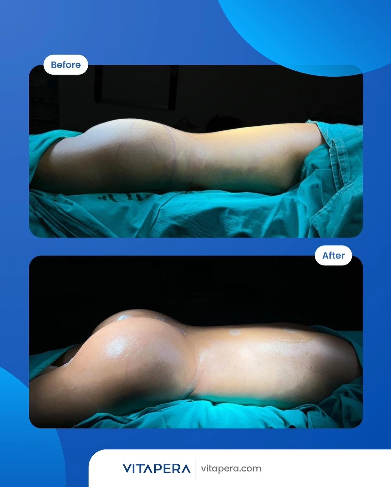 bum lift Our Results