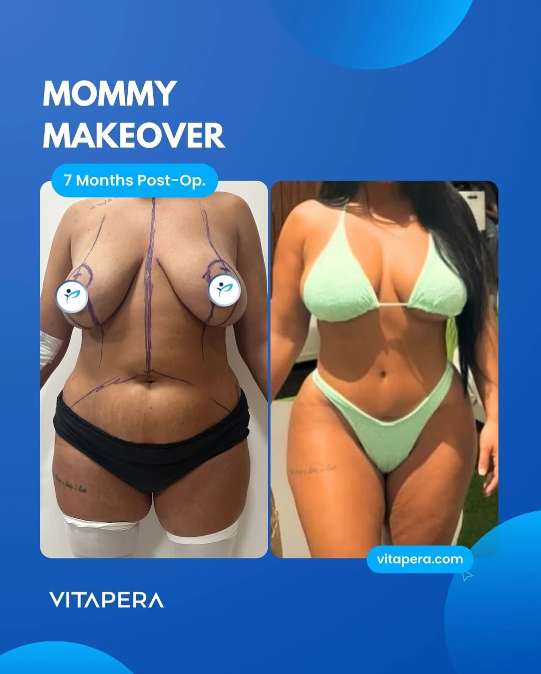 mommy makeover insta model Our Results
