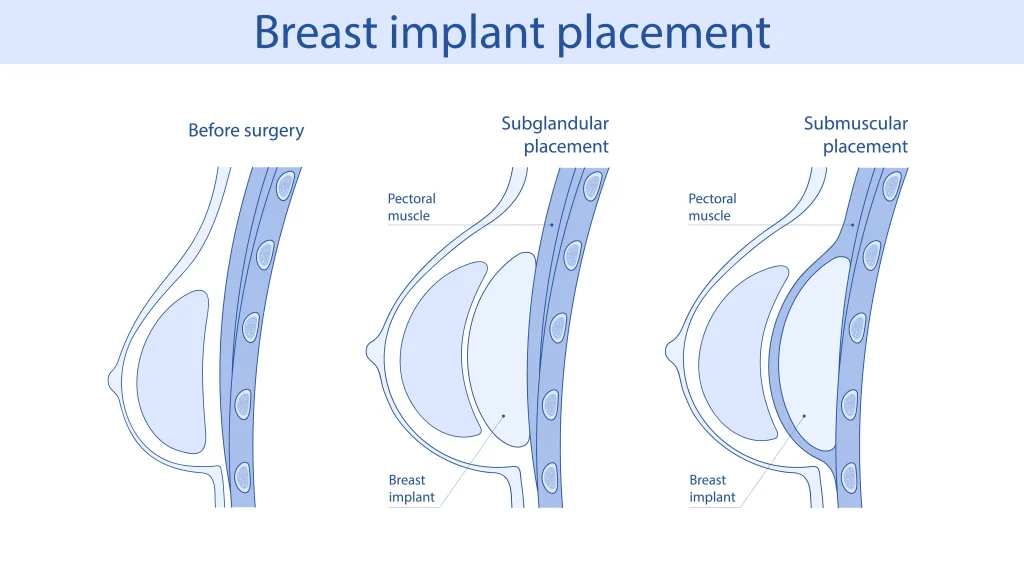 breast implant placement